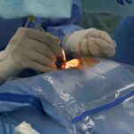 Cataract Surgery in Australia: Costs, Treatments, and What to Expect